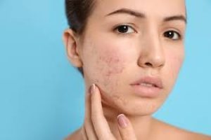 When To See A Dermatologist For Acne