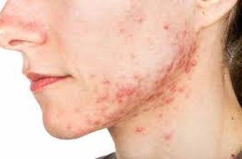 Cystic Acne