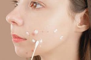 Benzoyl Peroxide in Skin Care: Benefits, Risks, and Uses