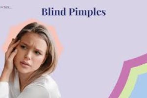 Blind Pimples: How to Get Rid of Those Stubborn Hard Pimples Under the Skin