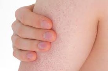 Bumpy, Rough Skin: Causes and Treatment Options