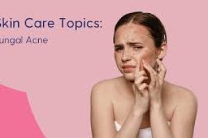 Skincare Secrets to Identify and Treat Fungal Acne Fast