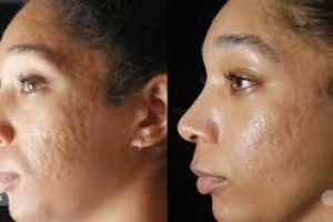 Timeline for Clearing Acne and Fading Acne Marks