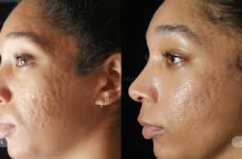 Timeline for Clearing Acne and Fading Acne Marks Timeline for Clearing Acne and Fading Acne Marks
