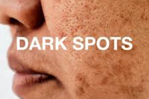 Dark Spots on Black Skin: Causes and How to Treat