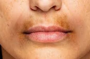Dark Patches Around the Mouth? Here’s How to Fade Hyperpigmentation Fast Dark Patches Around the Mouth? Here’s How to Fade Hyperpigmentation Fast