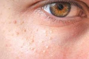 Milia and How To Remove Them ?