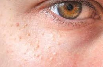 Milia and How To Remove Them ?