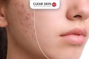 Clearer Skin Ahead: Skincare Solutions for Acne Scarring