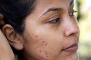 The Best Way to Treat Acne Scabs