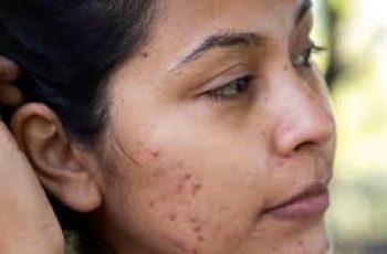 The Best Way to Treat Acne Scabs The Best Way to Treat Acne Scabs