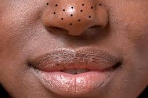 Clearer Skin Ahead: How to Deal with Blackheads Safely