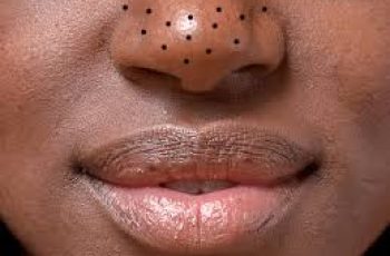Clearer Skin Ahead: How to Deal with Blackheads Safely Clearer Skin Ahead: How to Deal with Blackheads Safely