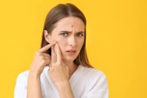 Can Kissing Cause Acne? What Dermatologists Want You to Know