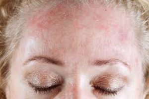 Seborrheic Dermatitis: How to Tackle Itchy, Flaky Skin Naturally