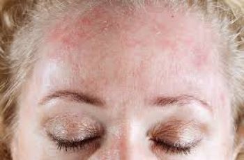 Seborrheic Dermatitis: How to Tackle Itchy, Flaky Skin Naturally