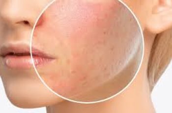 Common Skincare Ingredients That Trigger Facial Allergic Reactions