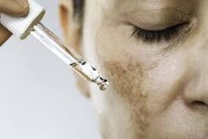 Understanding Hyperpigmentation: Causes, Types, and Effective Treatment Strategies