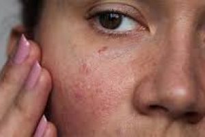 Effective Skin Care Strategies for Managing Skin Inflammation and Redness