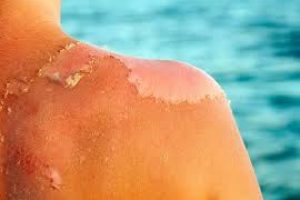 Why Your Skin Stings—Even with Just Water