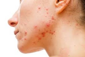 Dermatologists Explain Causes and Treatments for Ear Acne
