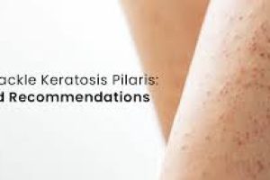 How Skincare Tackles Keratosis Pilaris Bumps and Dryness