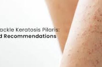 How Skincare Tackles Keratosis Pilaris Bumps and Dryness