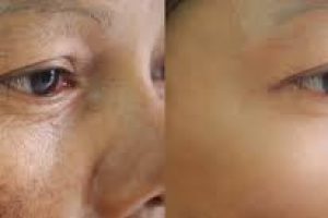 Clearer, Brighter Skin: Treating Uneven Tone Naturally
