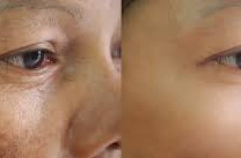 Clearer, Brighter Skin: Treating Uneven Tone Naturally
