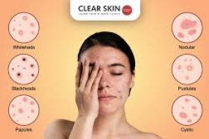 Top Causes of Acne + How to Treat It by Skin Type