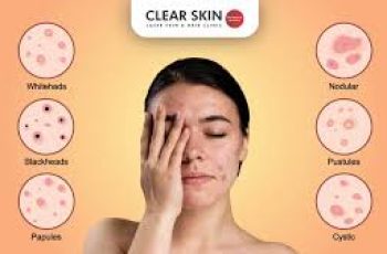Top Causes of Acne + How to Treat It by Skin Type