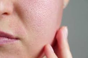 From Whiteheads to Blackheads: Understanding & Treating Clogged Pores