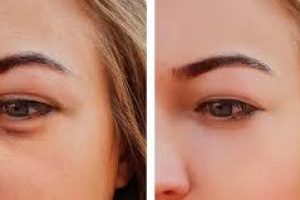 What Causes Puffy Eyes and How to Get Rid of Them
