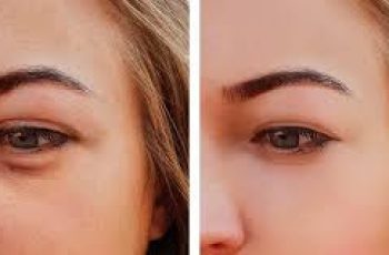 What Causes Puffy Eyes and How to Get Rid of Them