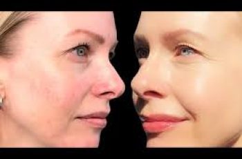 How Azelaic Acid Helps Reduce Rosacea and Redness
