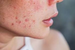 Why Not Popping Pimples Helps Heal Skin Without Scarring