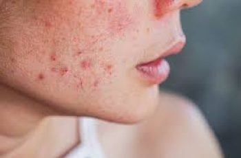 Why Not Popping Pimples Helps Heal Skin Without Scarring