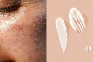 How Your Skin Changes After You Stop Retinol Use