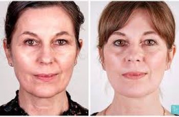 Liquid Facelift: Non-Surgical Skincare Solution for Youthful Appearance