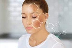Understanding Melasma: Causes, Skincare Tips, and Treatment Solutions