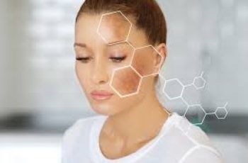 Understanding Melasma: Causes, Skincare Tips, and Treatment Solutions