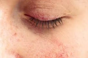 Understanding Ocular Rosacea: Symptoms, Causes, and Effective Treatments