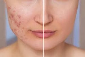 Scar Revision: Effective Treatments to Improve Skin’s Appearance