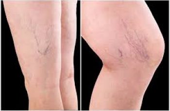 Sclerotherapy: Minimally Invasive Vein Treatment for Healthier Skin Sclerotherapy: Minimally Invasive Vein Treatment for Healthier Skin