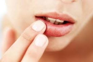 The Best Lip Treatments for Dry, Chapped Lips: Remedies That Really Work