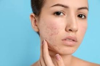 Should I See a Dermatologist for Acne? When and How to Get Professional Help Should I See a Dermatologist for Acne? When and How to Get Professional Help