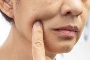 Weight Loss and Your Skin: The Reality of “Ozempic Face” and Effective Treatments