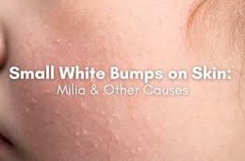 White Bumps on Skin? 7 Reasons and What To Do