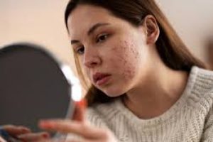 Think You Know Acne? 4 Common Myths Debunked by a Skin Expert