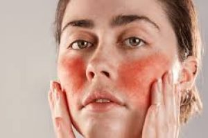 Effective Skincare Solutions for Soothing and Managing Rosacea